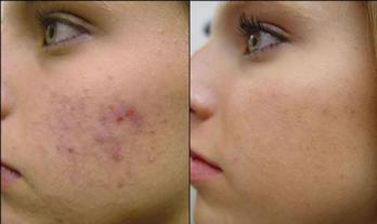 Bıttım Sabunu Faydaları