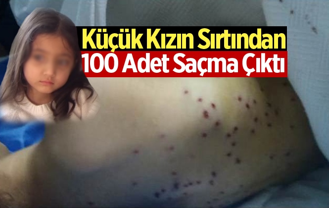 Mersin Tarsus’taki Olayda Küçük Kızın Sırtına 100 Tane Saçma İsabet Etti!