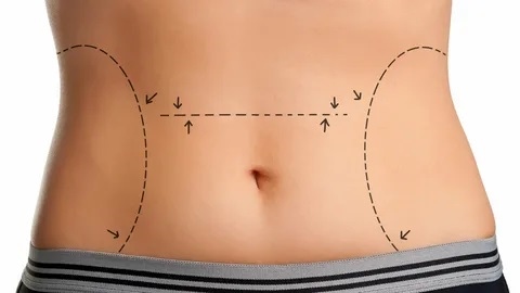 Liposuction Yöntemleri Nelerdir?