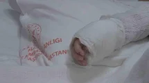 Üzerine Kaynar Su Dökülen Bebek Yanık Tedavisi Görüyor
