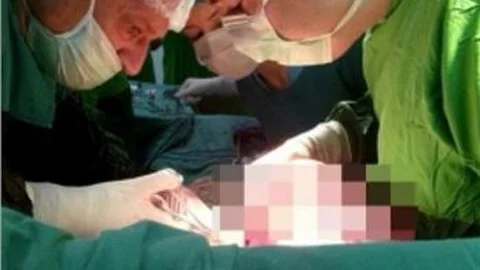 Öksürük Şikayetiyle Hastaneye Gitti Karnından 5,5 Kilo Ur Çıktı