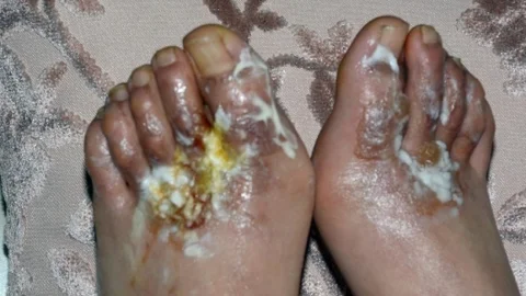 Erzurum'da Bir Genç Kızın Giydiği Ayakkabılar Nedeniyle Hastanelik Olduğu Öne Sürüldü