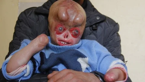 (Özel Haber) Minik Serkan'ın İçler Acısı Hali