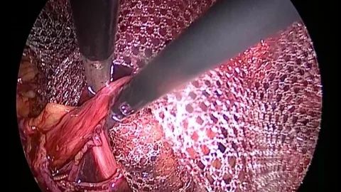 Doktor Şenol “Kasık Fıtığının Tek Tedavisi Ameliyattır”