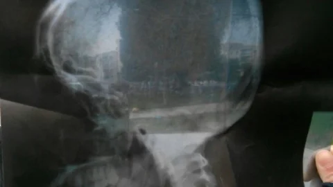 (Özel Haber) Kafasında Unutulan İğneler Sınırları Aştırdı