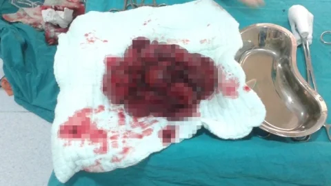 Karnından Üç Kiloluk Kitle Çıktı