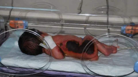 Siirt'te Hastane İhmalinde Yanık Bebek Olayı
