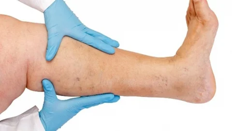 Varisten Ağrısız Kurtulma Yöntemleri