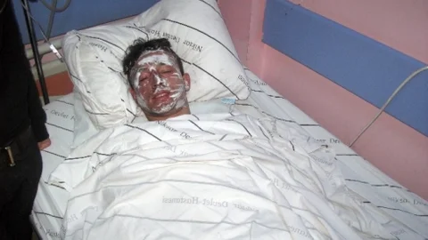 Tokat'ta Gençler Yanarak Yaralandı