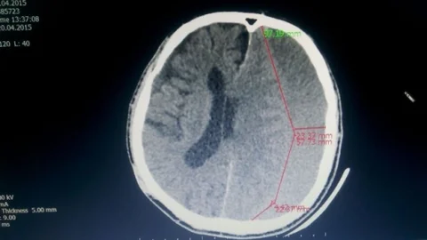 Kalp Hastasına Lokal Anestezi ile Ameliyat Yapıldı