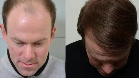 Saç Dökülmesi Tedavisi Yeniliklerle Geliyor