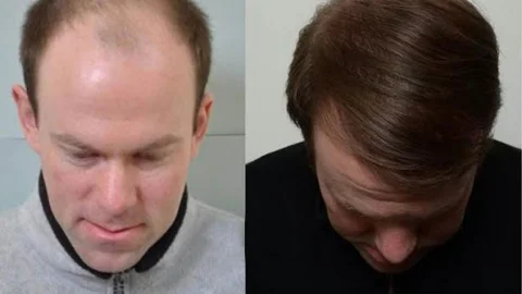 Saç Dökülmesi Organik Yöntemlerle Durduruluyor