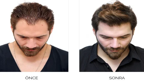 Saç Dökülmesine Organik Çözüm