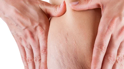 Doğum Sonrası Çatlaklar İçin Çözüm Yöntemleri