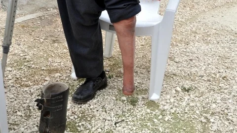 Şanlıurfa'da Protez Desteği Verilecek