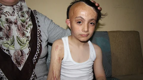 Mehdi'nin Yüzündeki Yanık İzleri İçin Yardım Bekleniyor