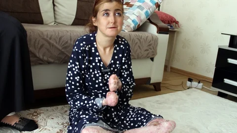 Diyarbakır'da Epidermolizis Bülloza Hastası Ebru, yardım talep ediyor