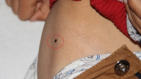 Samsun'da kene ısırdığı tespit edilen 7 yaşındaki çocuk hastaneye sevk edildi.