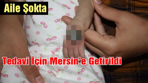 Yerinden çıkan Serum kelebeği bebeğin elini çürüttü