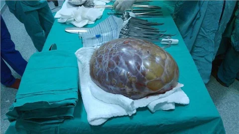 Karnından 6 kiloluk kitle çıkarıldı