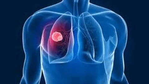 Tüberküloz Hastalarında Akciğer Kanseri Riski 2 Kat Fazla! Tüberküloz Nedir Belirtileri Nelerdir