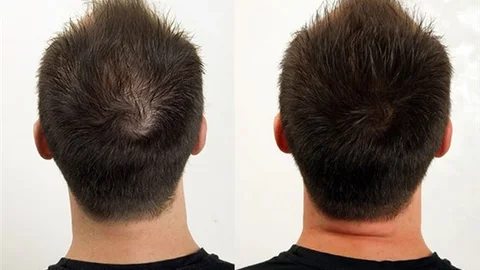 Canlı Saçlar İçin Bunu Yapın!! Saç Mezoterapisi Nedir Nasıl Yapılır?