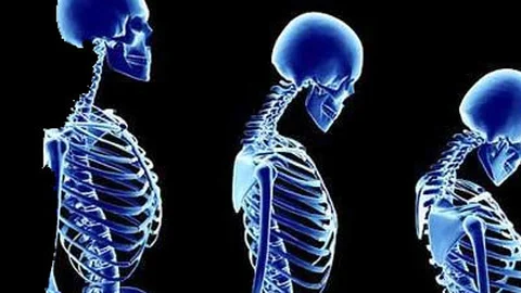 Kemik Erimesi Erkeklerde de Başladı!!!