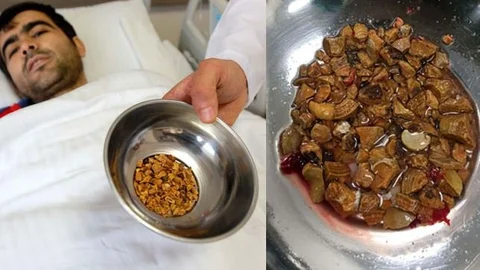 Mersin'deki Hastanın Böbreğinden 300 Taş Çıktı!!!