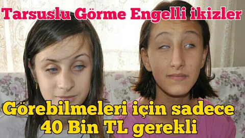 GÖRME ENGELLİ  İKİZLER TÜRKİYE GÜNDEMİNDE