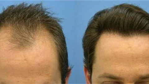 Saç Simülasyonu Başladı! Ağrılı Saç Ekimi Tarih Oluyor