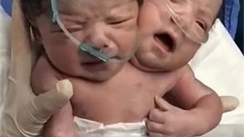 İKİ BAŞLI BEBEK DOĞDU