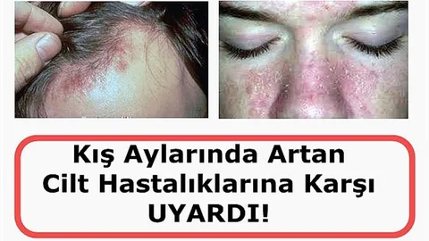 KIŞIN CİLT HASTALIKLARI ARTIYOR