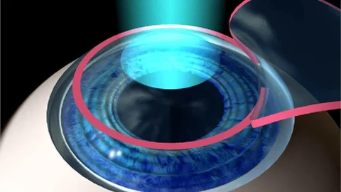 Excimer Laser Nedir?