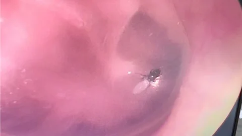 Piknikte Kulağına Kaçan Sinek, Tıbbı Operasyonla Çıkarıldı