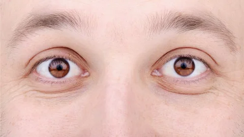 Uykusuzluk Göz Kapağı Sarkmasına Sebep Oluyor