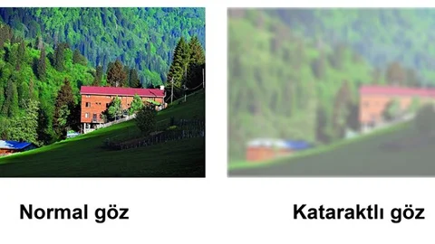 Katarakt Hakkında Bilmek İstediğiniz Herşey