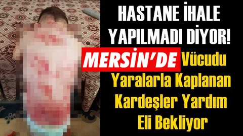 Vücudu Yaralarla Kaplı Çocuklar Yardım Bekliyor