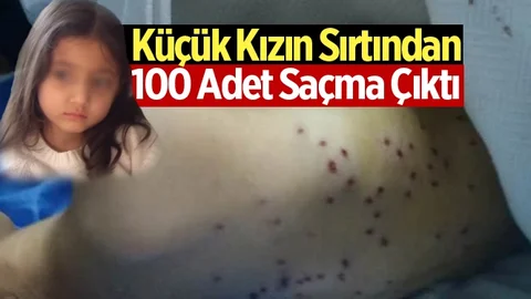 Mersin'de Küçük Kızın Sırtına 100 Tane Saçma İsabet Etti!