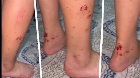 DÜĞÜN DE ATILAN HAVAYİ FİŞEK ÇOUĞU YARALADI