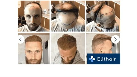 DHI Saç Ekimi Nedir? Kalıcı Olması Mümkün Mü?