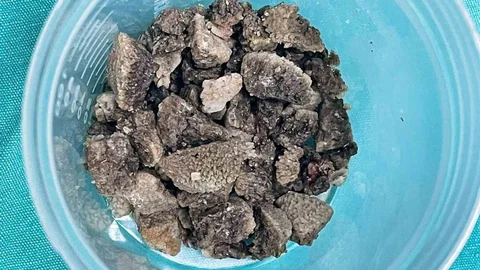 Malatya'da 8 santimetrelik böbrek taşı kapalı yöntemle çıkarıldı