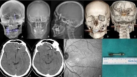 Bursa'da implant skandalı: İki yıldır adalet bekliyor