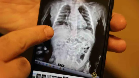 Diyarbakır'da Doğuştan Hastalıkla Yaşayan Çocuk Şifa Buldu