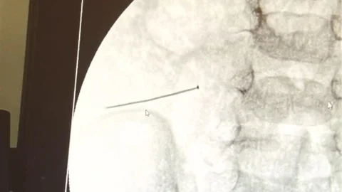 2 Yaşındaki Çocuğun Bağırsağından İğne Çıktı