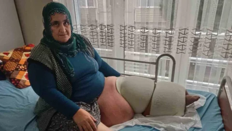 35 Yıldır Fil Hastalığıyla Savaşan Tarsuslu Cennet Teyze: " Yeniden Yürüyebilmek İçin Destek Bekliyorum "