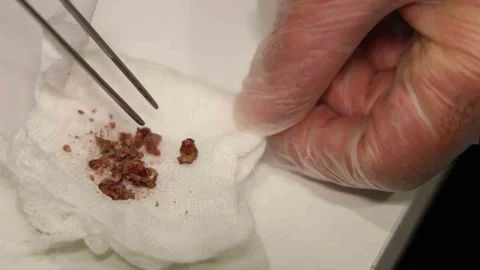 Elazığ'da Burundan Taş Çıktı