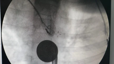Siirt'te Çocuk Boğazına Para Kaçırdı