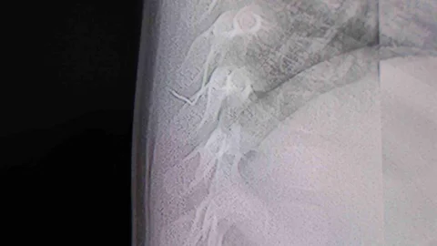 Bebeğin Sırtından Metal Tel Parçası Çıktı