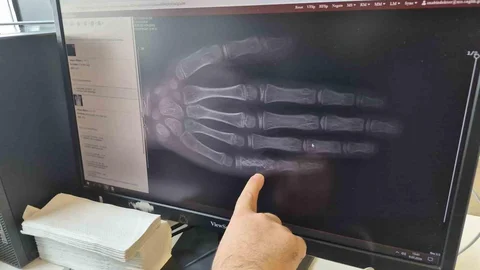 Eskişehir'de Çocukluk Çağı Kanseri Vakaları Artıyor