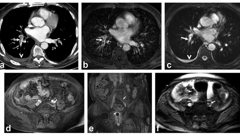 Akciğer Pıhtılarında Radyasyonsuz Çözüm
